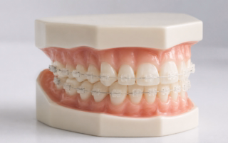 3M Clarity Brackets The Clear Choice for Professional Adults